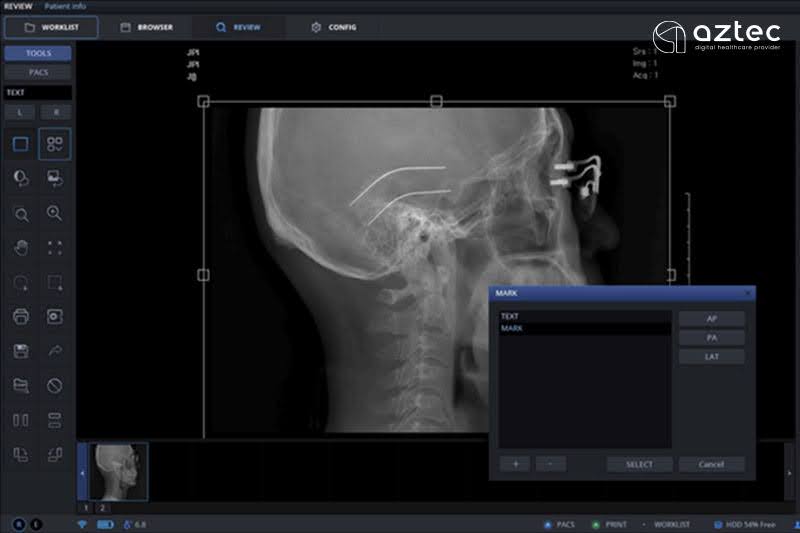 ภาพผลเอซเรย์จากโปรแกรม Zview โปรแกรมสําหรับแผ่น DR ยี่ห้อ PIXXGEN